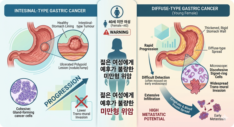 젊은 여성 위암 폐암보다 무섭다 펩시노겐 검사로 미리 예방하세요