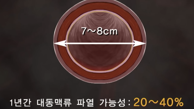 허리 통증인 줄 알았는데 혈관 문제 복부 대동맥 폐쇄증과 척추 질환 구별법